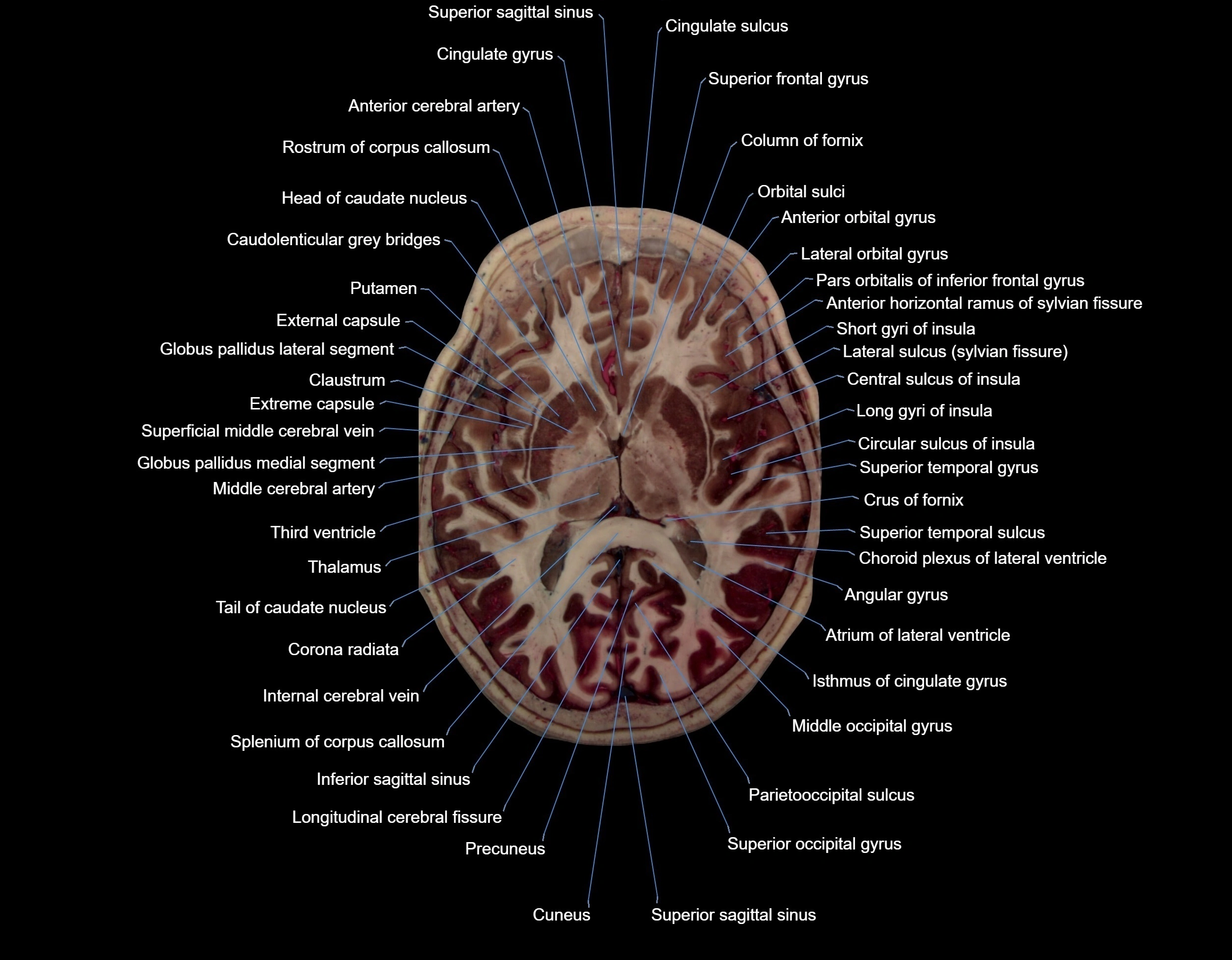 MRI Brain axial cross sectional radiology anatomy 3T image  -img-000043.webp
